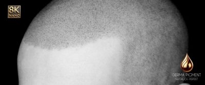 derma_pigment2