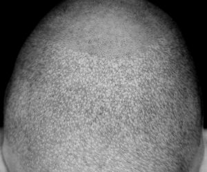 dermapigment-smp-haarpigmentierung dermapigment-smp-haarpigmentierung