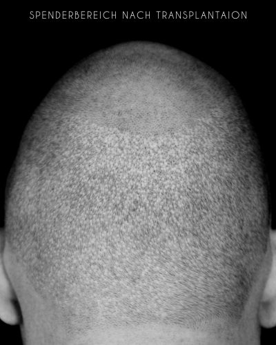 dermapigment-smp-haarpigmentierung