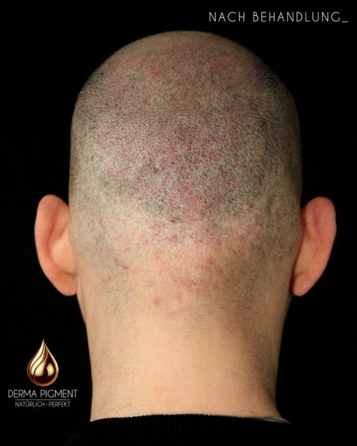 dermapigment-smp-haarpigmentierung