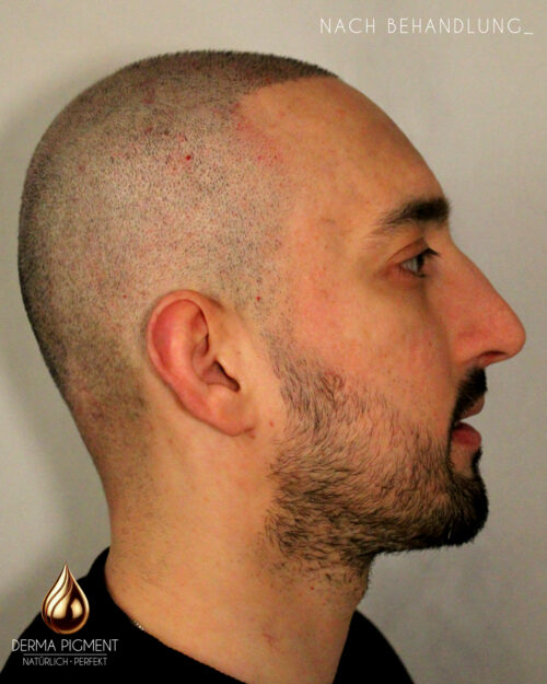 dermapigment-smp-haarpigmentierung