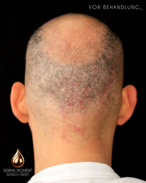 dermapigment-smp-haarpigmentierung