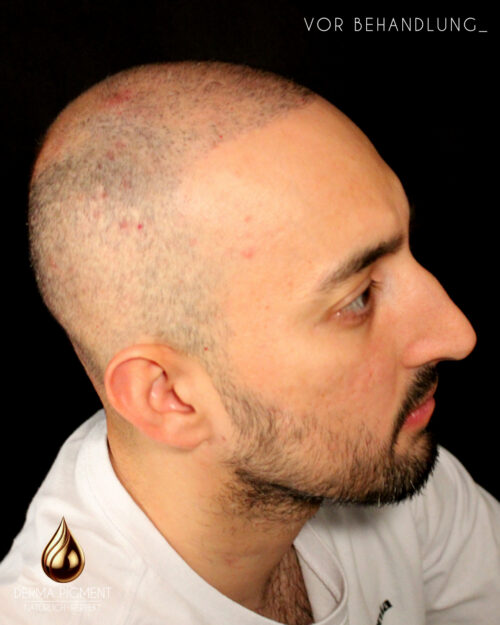 dermapigment-smp-haarpigmentierung