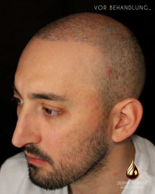 dermapigment-smp-haarpigmentierung